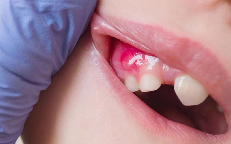 Absceso dental abstracto