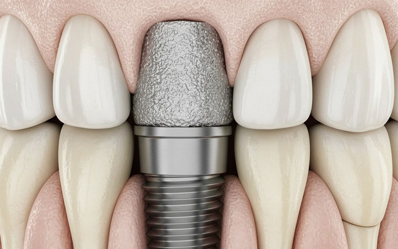 Successful dental implant in jawbone