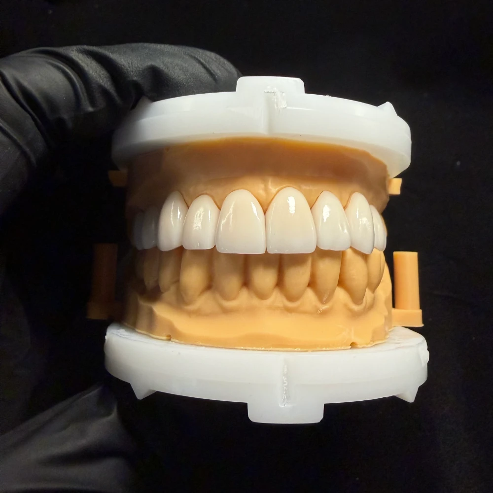 Cosmetic Veneers (1)