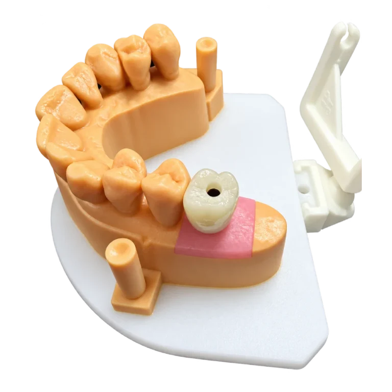 Implant Layered Zirconia Crown (3)