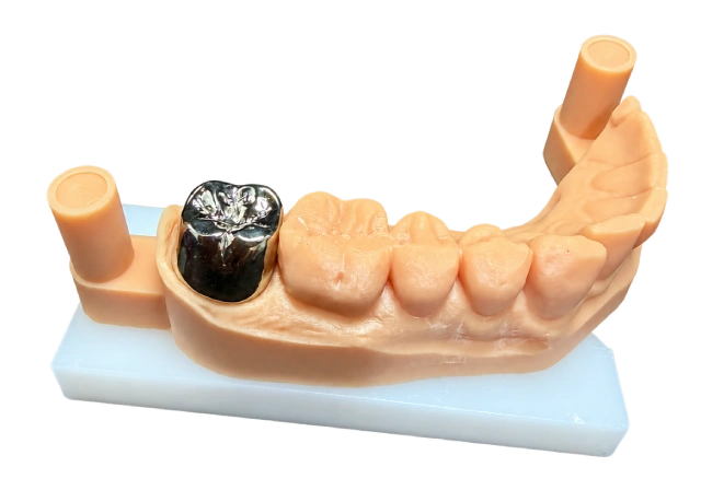 PFM Crowns and Metal Framework
