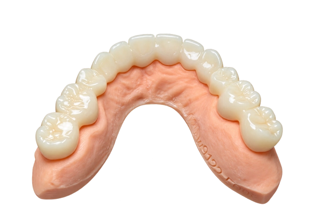 Temporary Dental Bridge